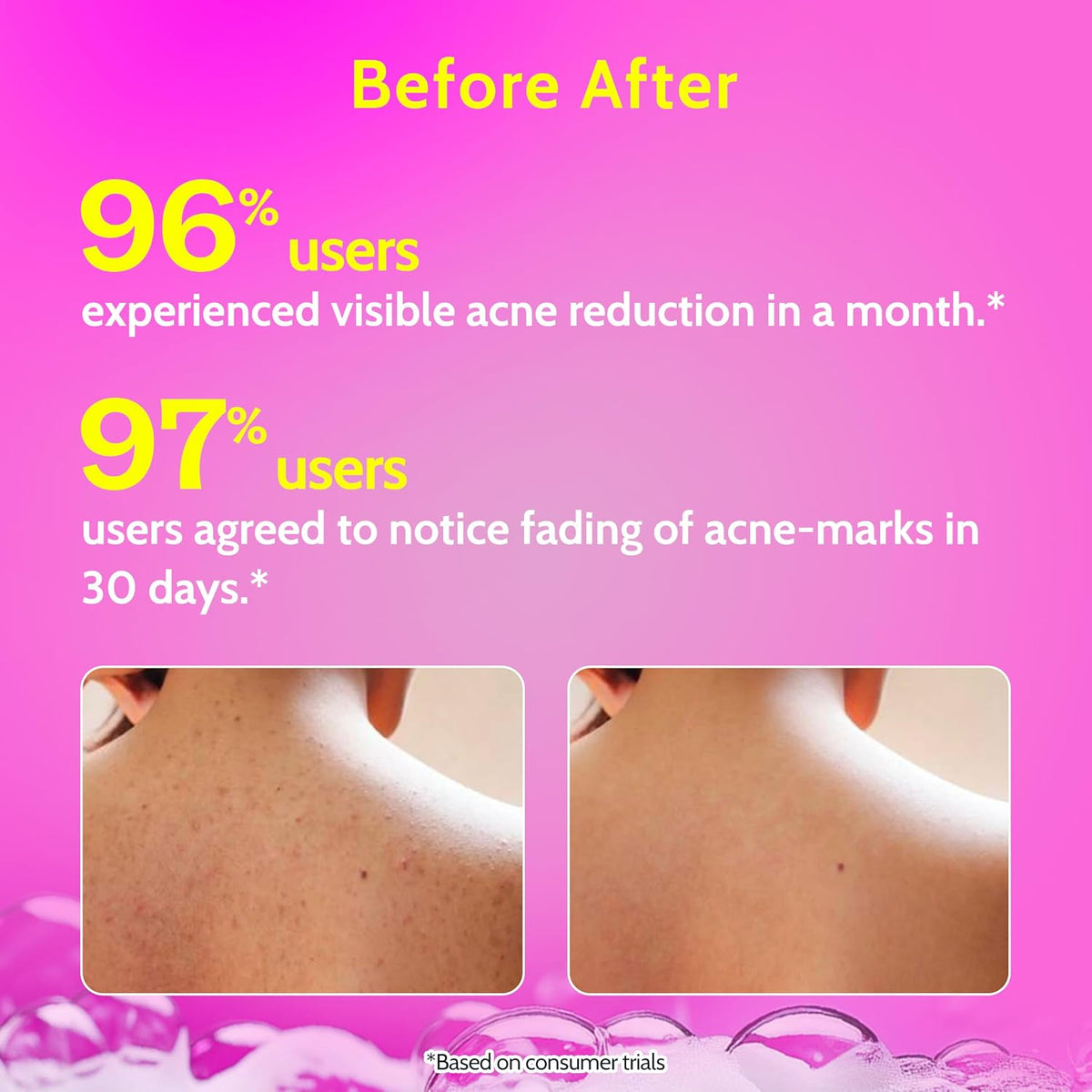 Chemist at Play Salicylic Acid Acne Body Wash